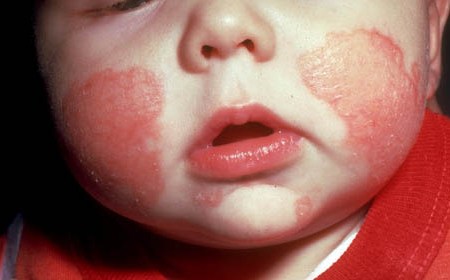 Ребенок с аллергическим дерматитом