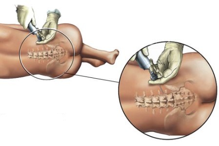 Схема проведения спинальной анестезии при кесаревом сечении.
