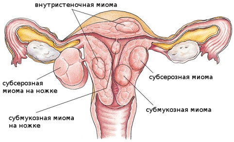 Схема расположения миомы в матке