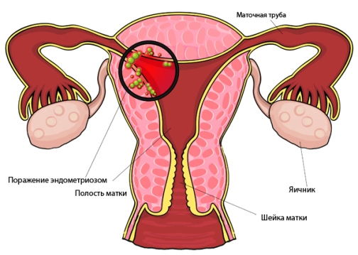 Эндометриоз матки: схема