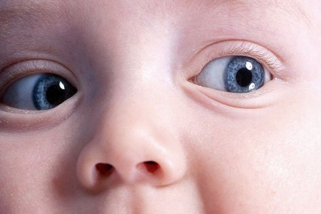 Глаза младенца: ретинопания недоношенных
