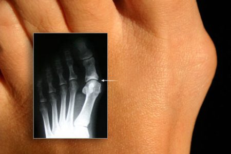 Косточка на ноге – вальгусная деформация большого пальца