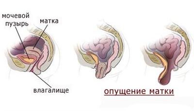 Схема опущения матки