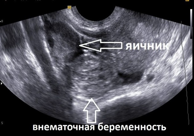 Признаки внематочной беременности на УЗИ: увеличенная матка, скопление жидкости, кровяной сгусток, кисты, повышенная выработка секрета железами эндометрия