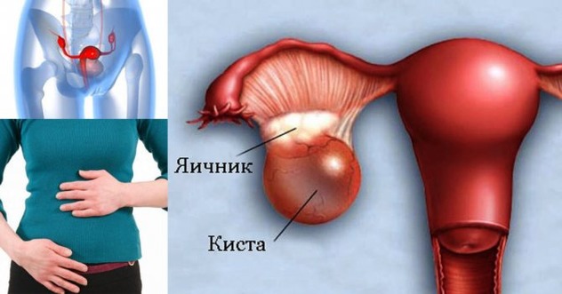 Боль в яичнике может появиться из-за кисты, внематочной беременности, опухоли 