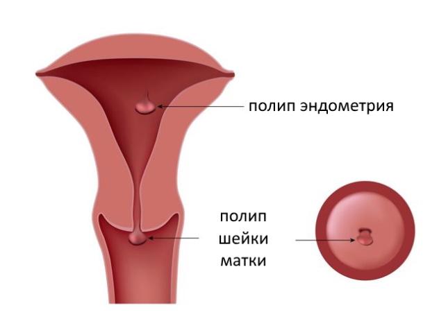 полип эндометрия и шейки матки