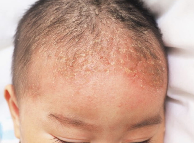 себорея как причина выпадения волос у ребенка