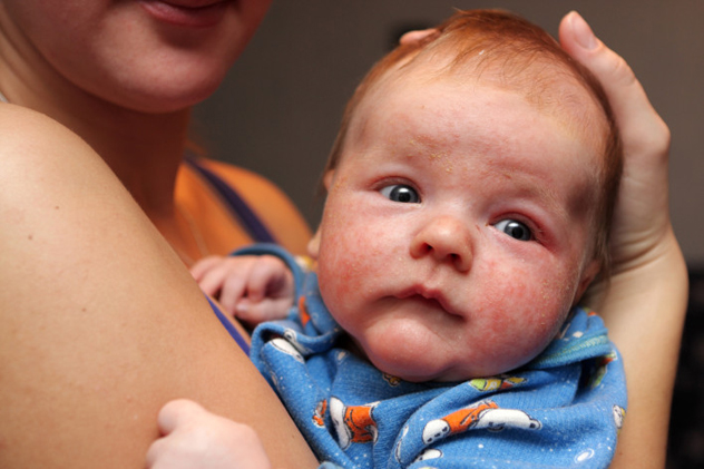 атопический дерматит на лице малыша