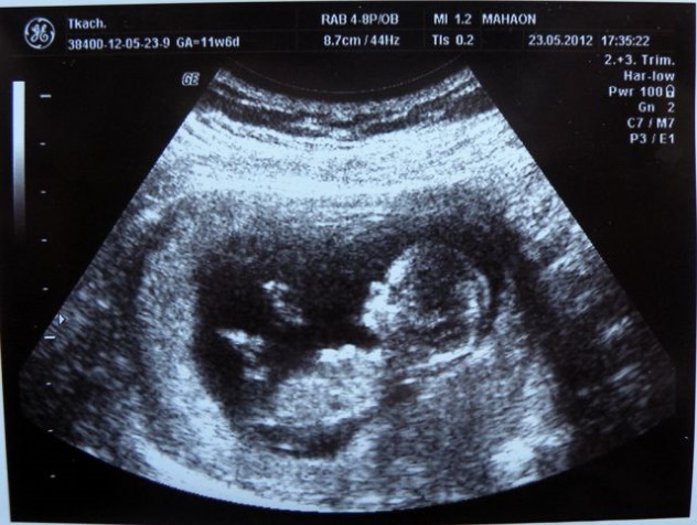 Снимок УЗИ на 12 неделе беременности