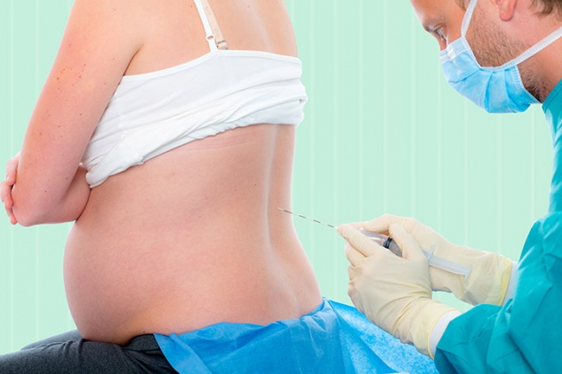 беременной вводят эпидуральную анестезию