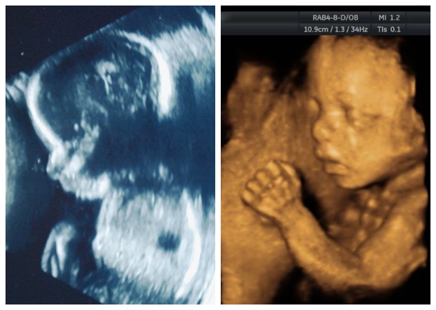Фото 2D и 3D УЗИ при беременности
