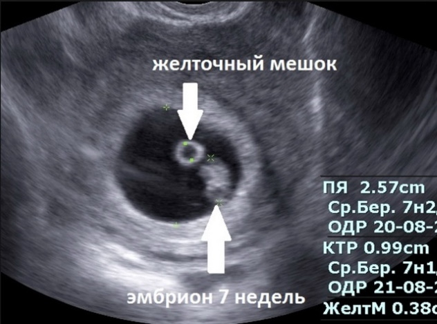 Фото узи на ранних сроках беременности: желточный мешок