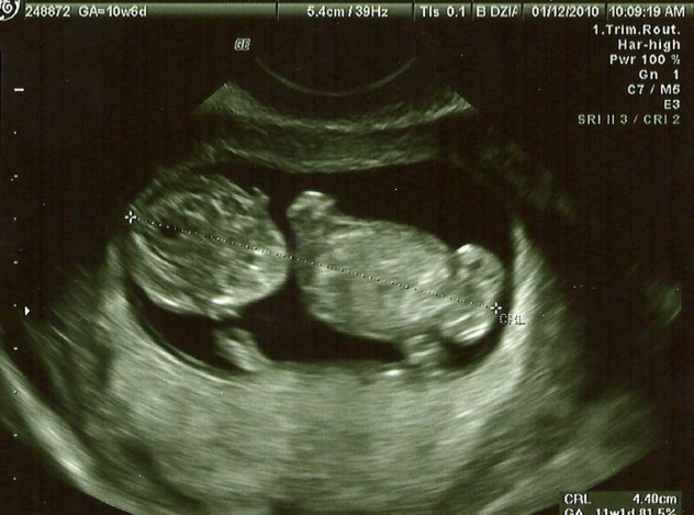 фото первого узи при беременности