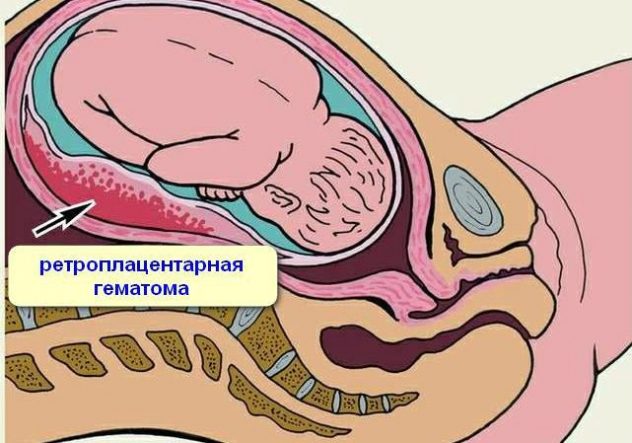 Ретроплацентарная гематома при беременности