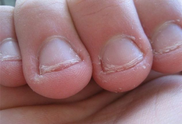 последствия обгрызания ногтей