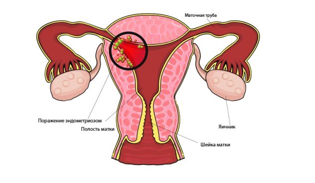 Дюфастон назначается не только при задержке месячных, но и при эндометриозе
