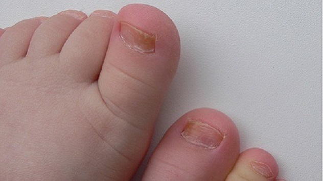Грибок ногтей на ногах у детей