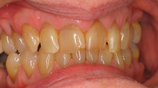 желтые зубы 