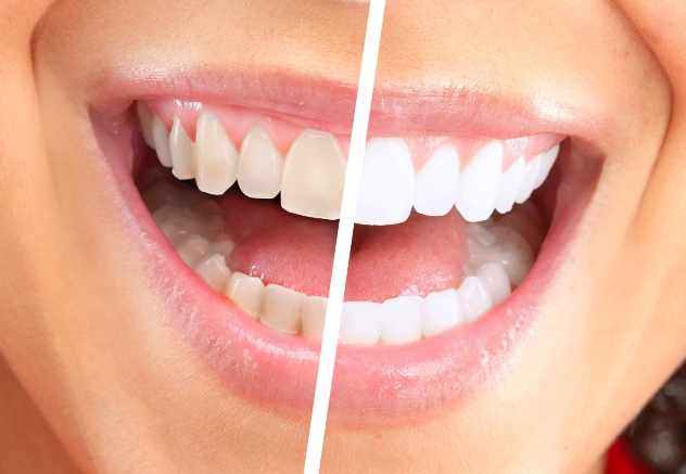 сколько стоит отбеливание зубов у стоматолога