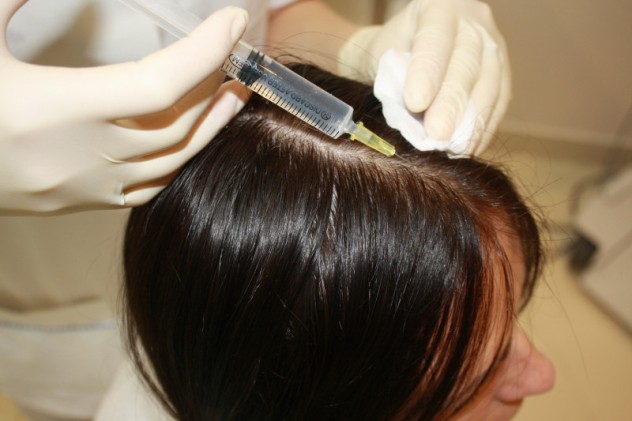 мезотерапия волос 