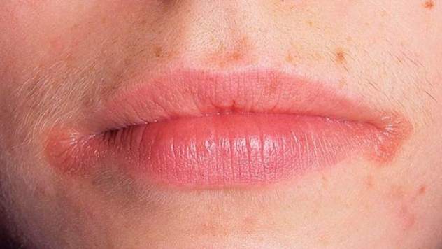трещины в уголках губ могут возникать по разным причинам