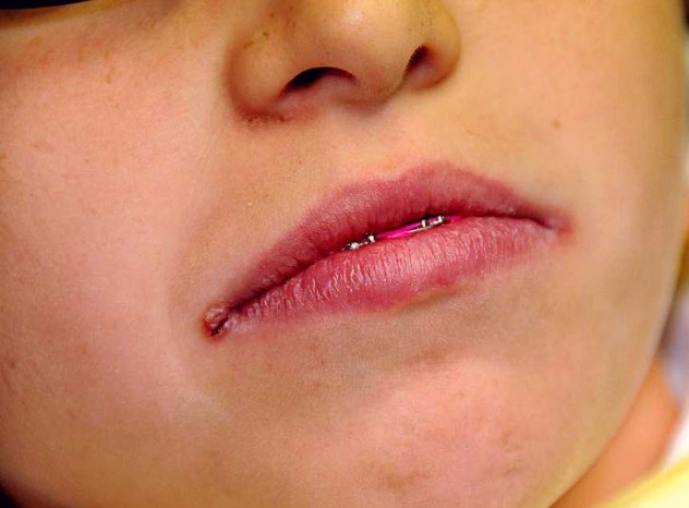 трещины в уголках губ
