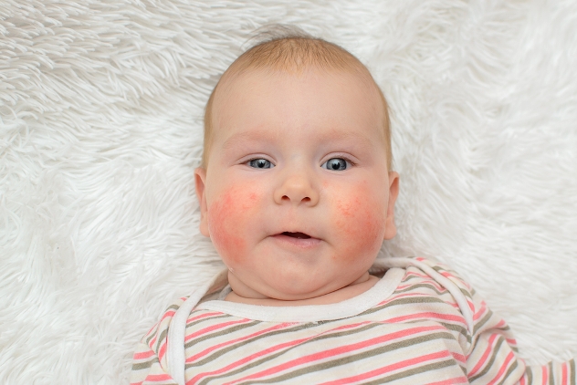 смекта может вызвать аллергию у детей