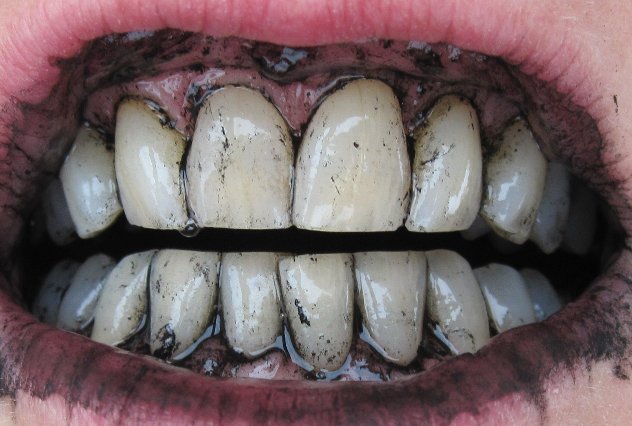применение активированного угля для отбеливания зубов