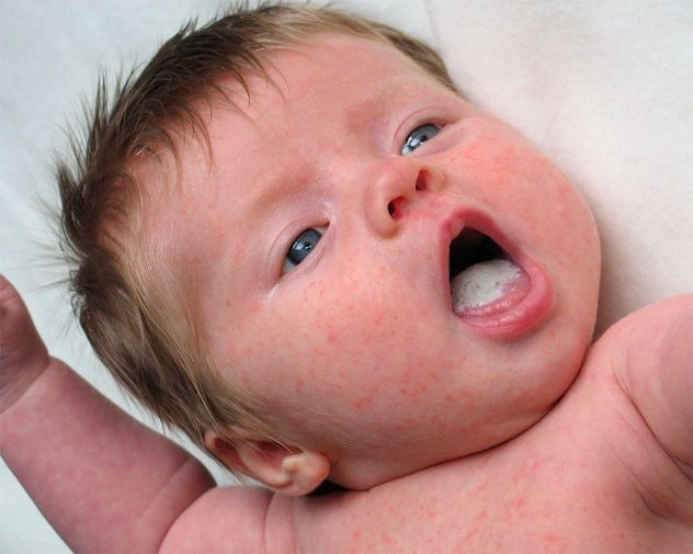 аллергический белый налет на языке у ребенка