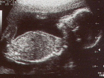 Мальчик 21 неделя. УЗИ 21 неделя беременности профиль. Движения малыша на 21 неделе.