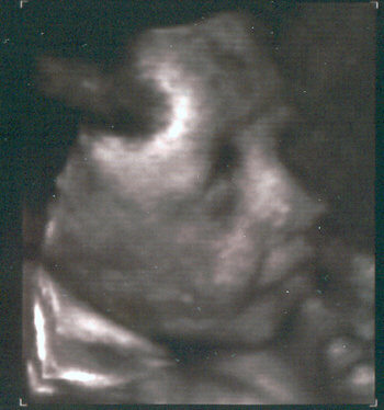 35 недель тошнит. 3д в 19 недель беременности. УЗИ снимки в утробе с ДЦП. Как бывает ребенок в животе жуткие фотографии в УЗИ.