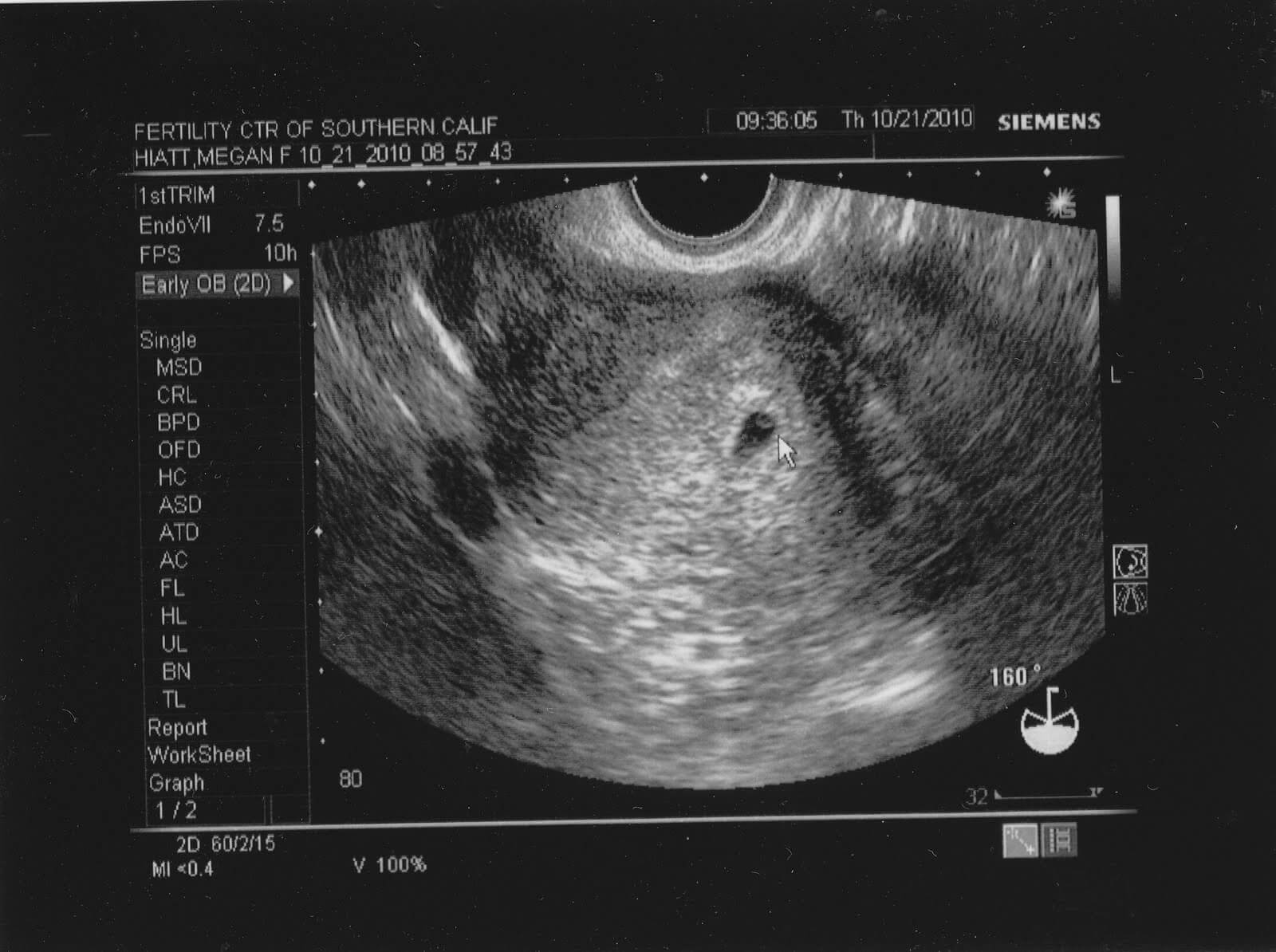 Что есть на первых неделях беременности. Как выглядит эмбрион в 5 недель на УЗИ. Эмбрион на 3 неделе беременности УЗИ. Как на УЗИ выглядит плод 3-5 неделя. 3 4 Недель беременности фото эмбриона на УЗИ.