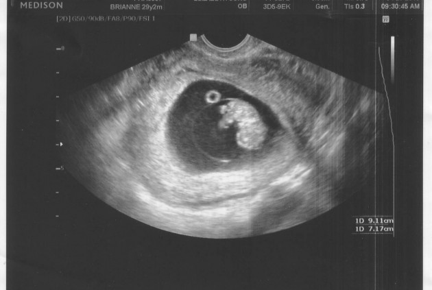 Как выглядит ребенок на 9 неделе беременности фото
